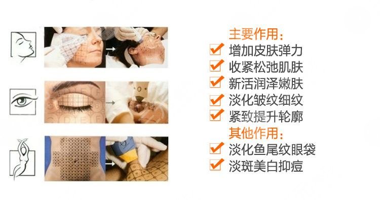 热玛吉果后遗症