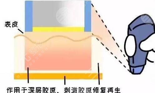 做热玛吉后注意哪些
