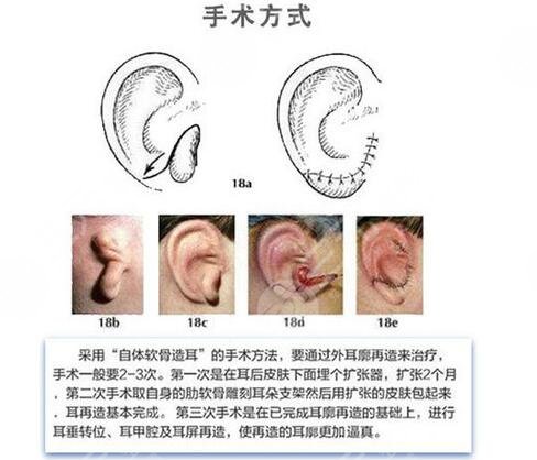 耳再造手术费用
