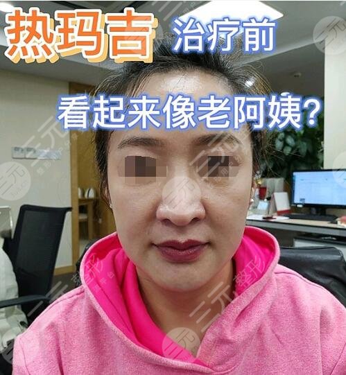 热玛吉前