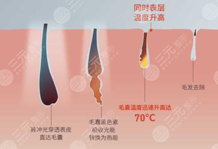 做激光脱毛的注意事项