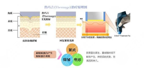 热玛吉四代一次多少钱