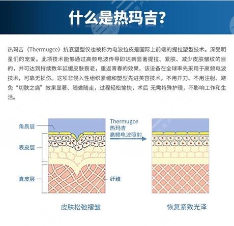 北京五代热玛吉做一次大概多少钱