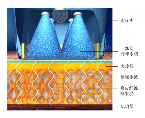 热玛吉一个部位多少钱