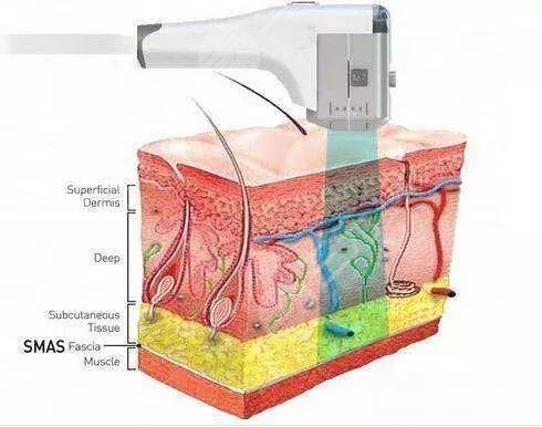 热玛吉可以去皱纹吗