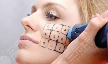 热玛吉可以去皱纹吗