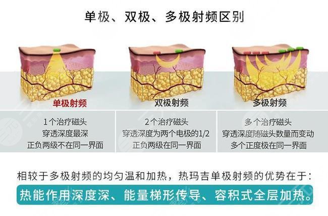 美容院热玛吉一次多少钱