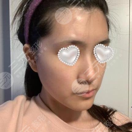 耳软骨垫鼻尖整形前