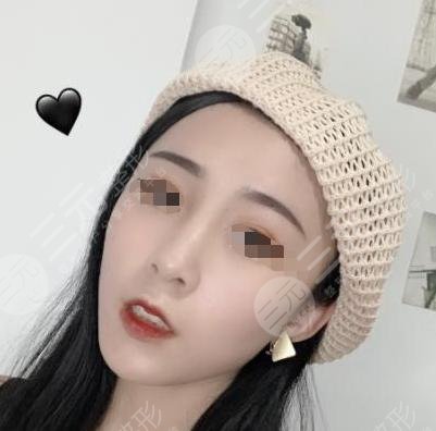 曼特波假体隆鼻整形后一个月