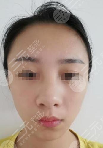 曼特波假体隆鼻整形前
