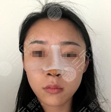 曼特波假体隆鼻整形后一周
