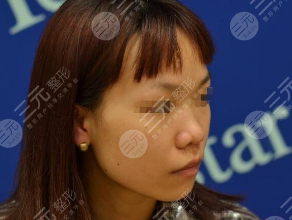 超体隆鼻真人整形案例前