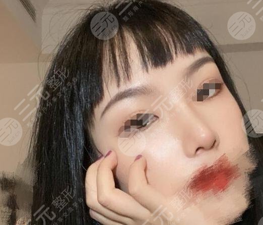 超体隆鼻真人整形案例后