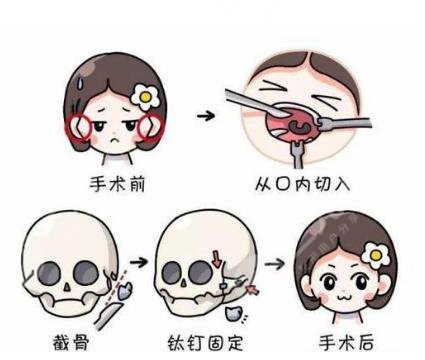 颧骨太突出怎么改良不做手术可以吗