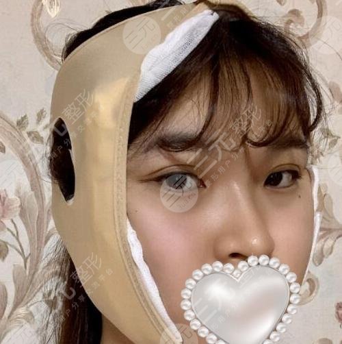 颌面手术整形后一周
