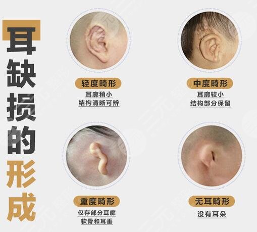 杯状耳矫正矫正时机