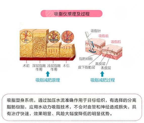 上海腰腹环吸价格