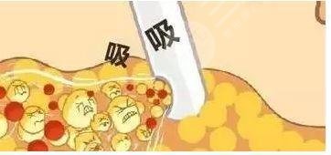 上海腰腹环吸价格