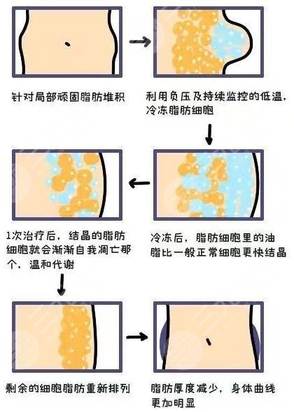 酷塑冷冻减脂副作用