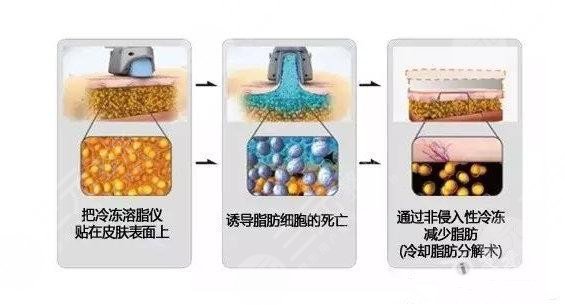 酷塑冷冻减脂副作用