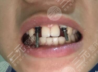 六安高峰口腔价格表