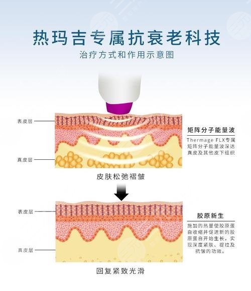 热玛吉的工作原理介绍
