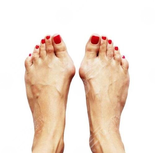 拇外翻手术治疗大概多少钱费用参考术后注意事项科普