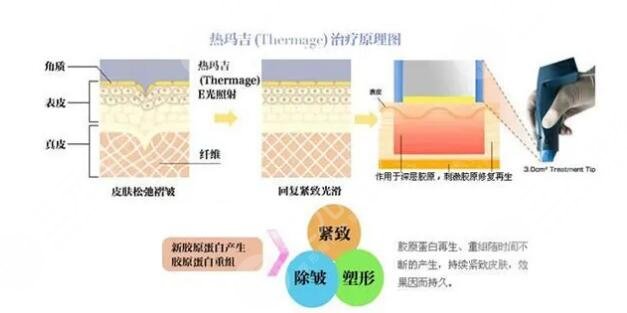 热玛吉缓解原理