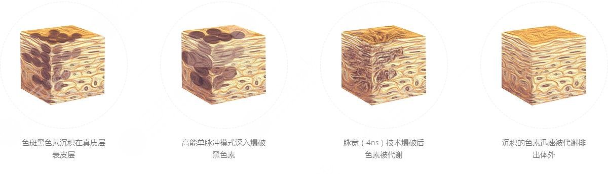 欧洲之星祛斑价格