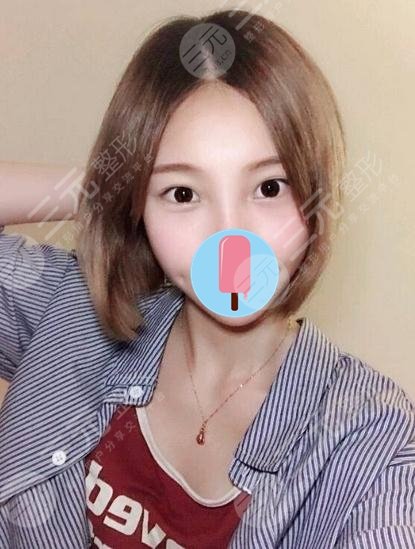 去眼袋后
