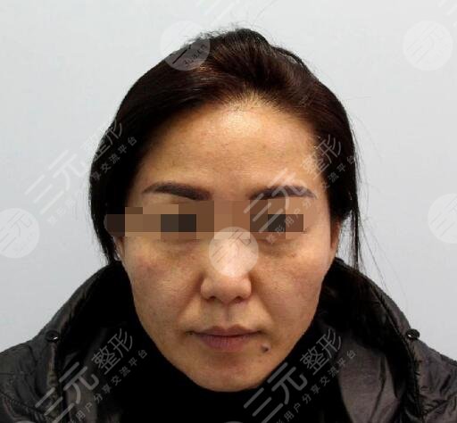 热玛吉术前