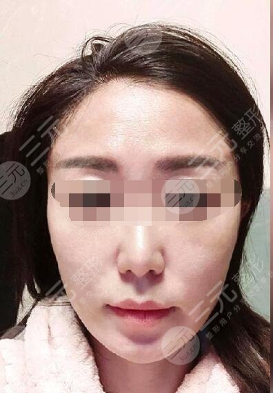 热玛吉术后