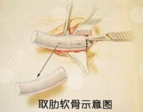 肋软骨隆鼻取肋骨过程详情解析：肋软骨隆鼻亲身果记录并分享~