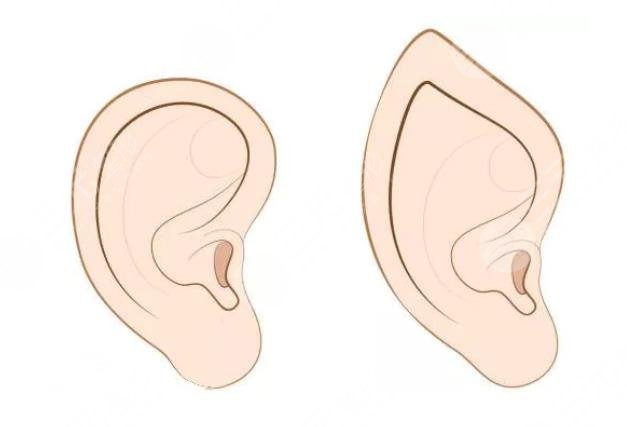 颅耳角在30°-60°之间朵怎么整形