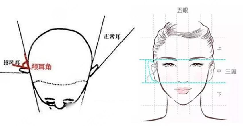 颅耳角在30°-60°之间朵怎么整形