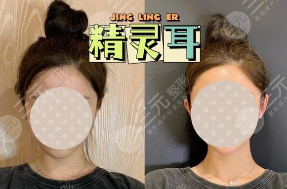 颅耳角在30°-60°之间朵怎么整形