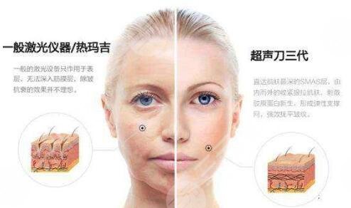 热玛吉优势