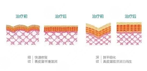 热玛吉的作用原理