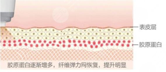 热玛吉除皱的原理