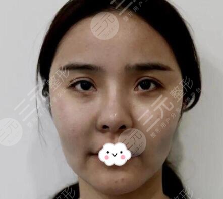 热玛吉前