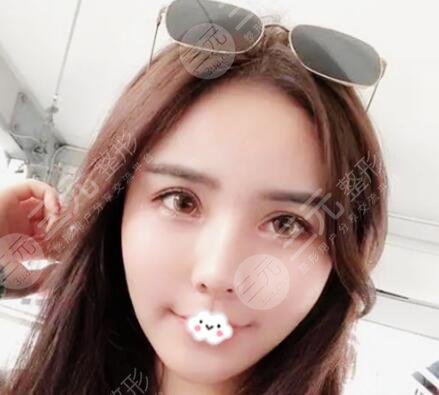热玛吉后