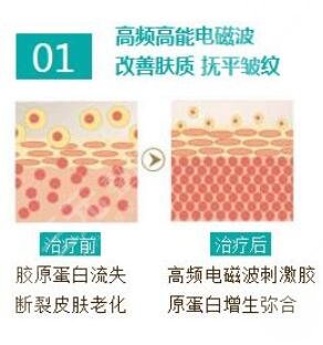 热玛吉的原理是什么