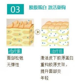 热玛吉