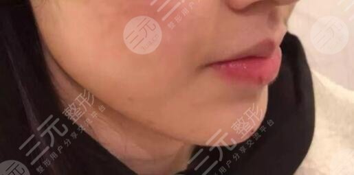 热玛吉术后