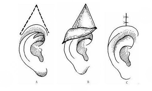 耳再造手术的注意事项