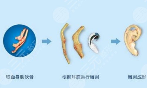 耳再造手术的优势