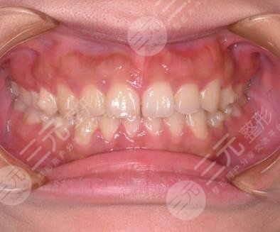 上海瑞泰口腔医院隐形牙齿矫正经历分享