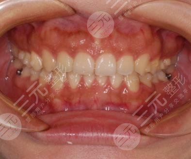 上海瑞泰口腔医院隐形牙齿矫正经历分享