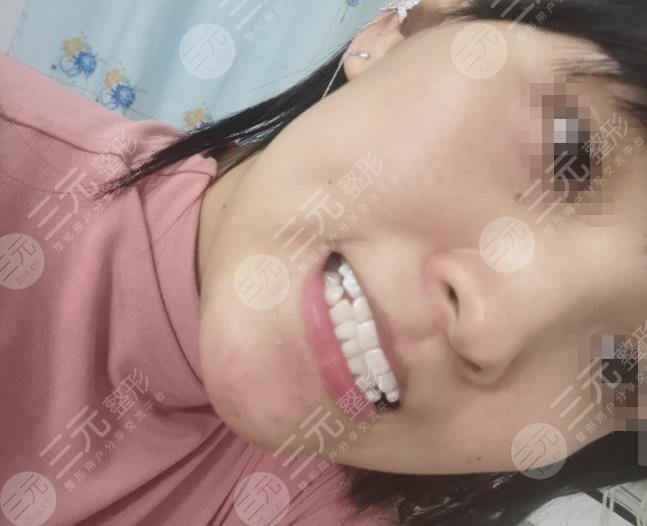 南京美奥口腔医院牙齿美白经历分享