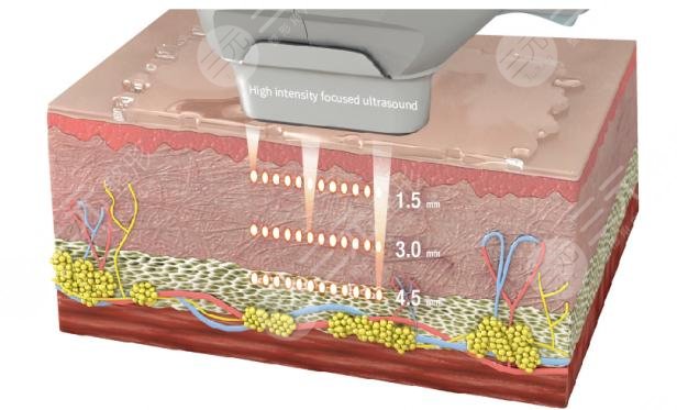 7d聚拉提果维持多久